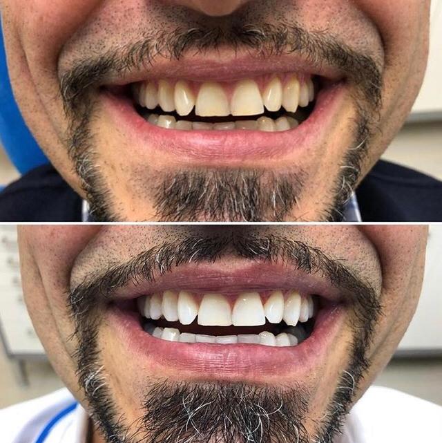 Prima e dopo lo sbiancamento dentale
